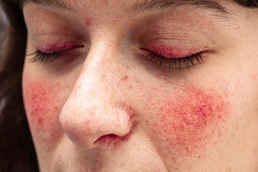 Lichttherapie bij rosacea: realistisch uitgelegd